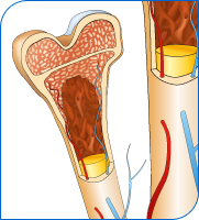 Bone Marrow 13