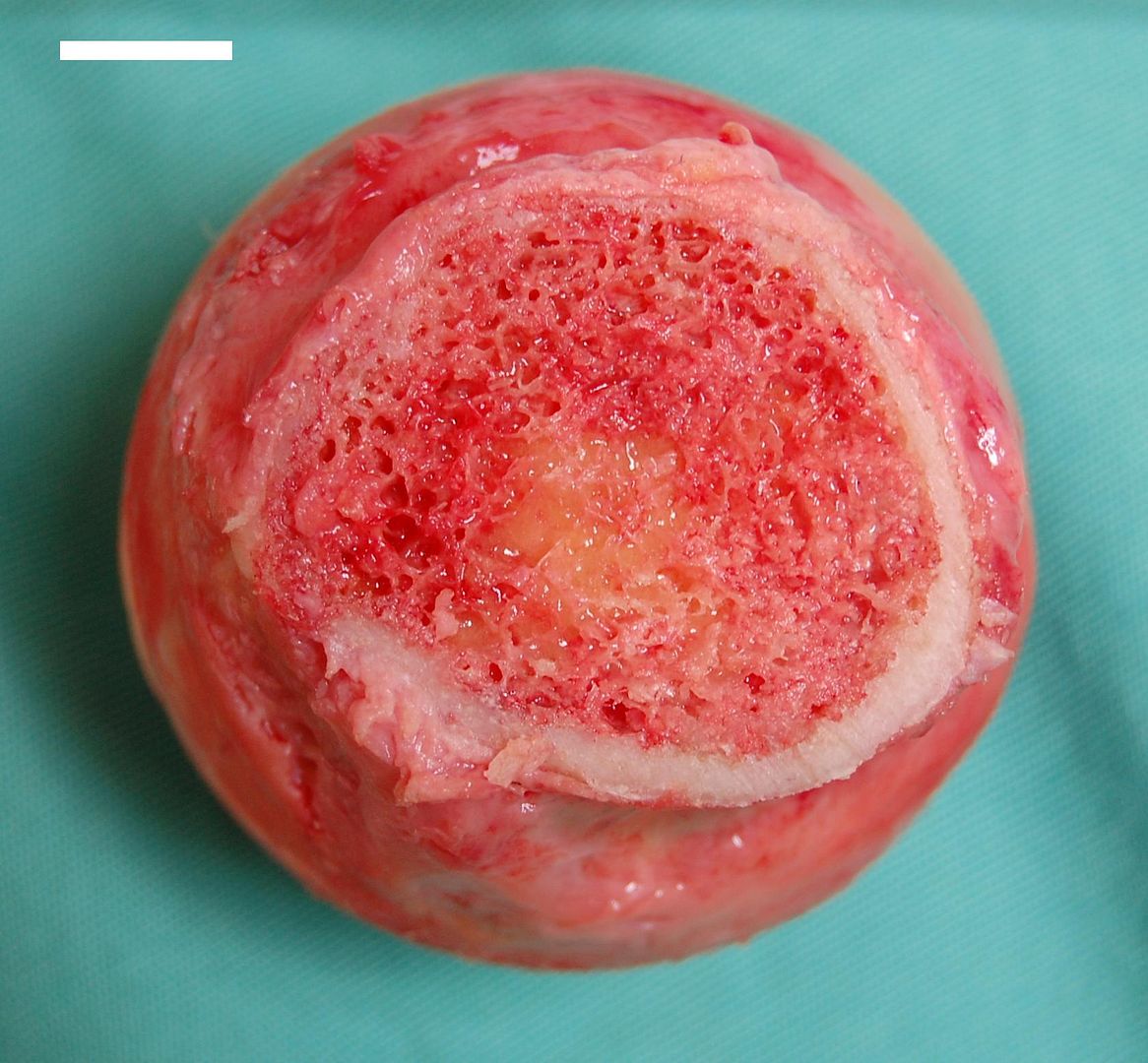 Bone Marrow 5